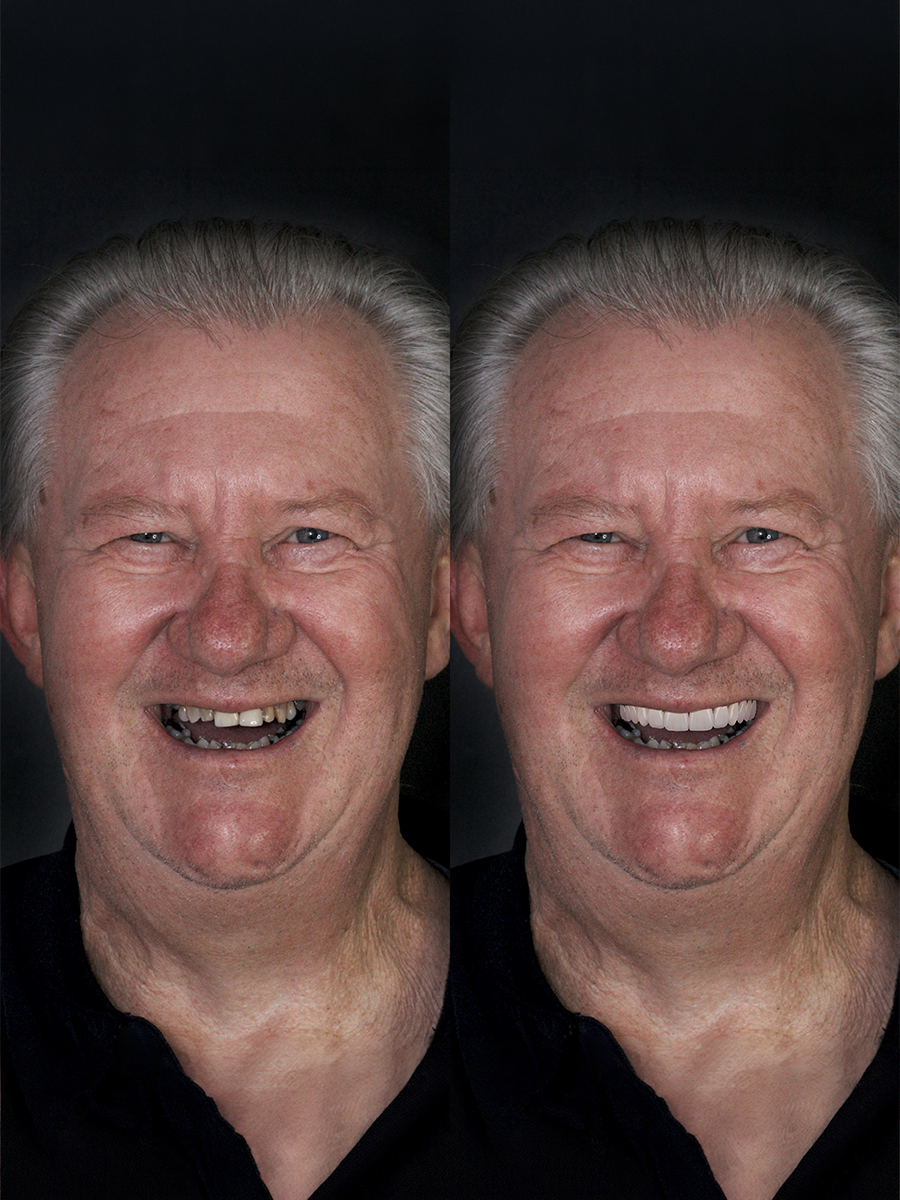 Sorriso transformado com lentes de porcelana — Dr. Vítor Carboni