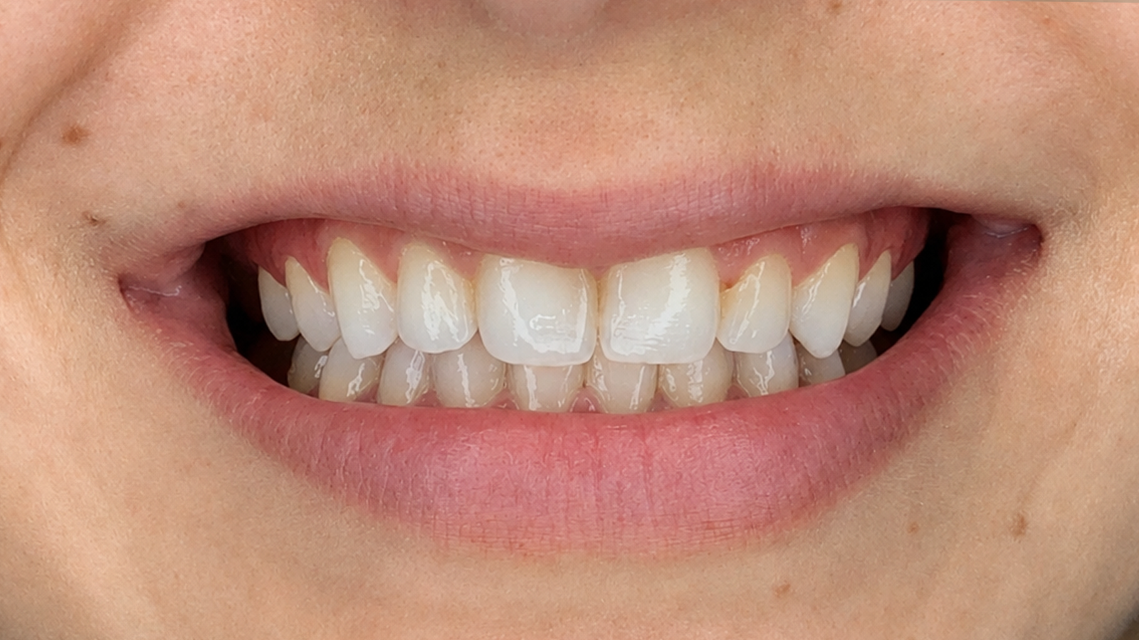 Sorriso antes das lentes — Dr. Vítor Carboni
