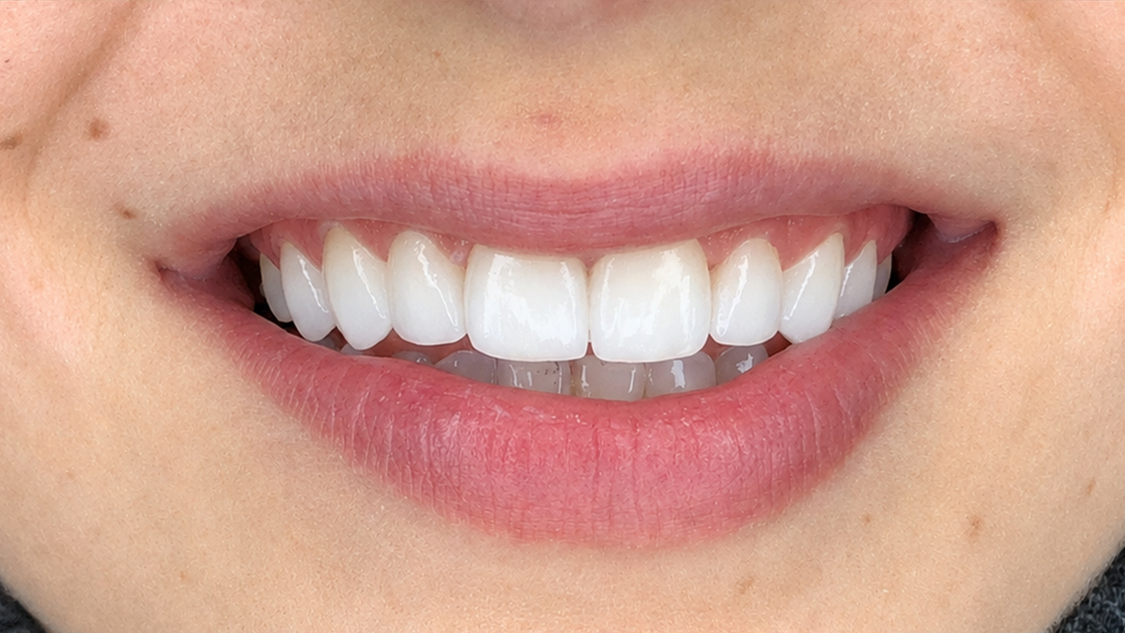 Sorriso depois das lentes — Dr. Vítor Carboni